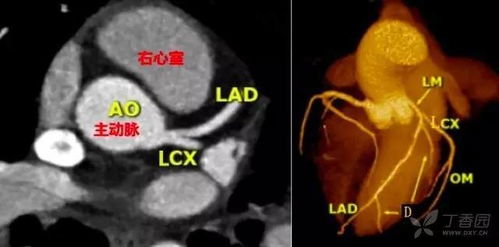 lcx om artery,LCX OM Artery: A Comprehensive Overview